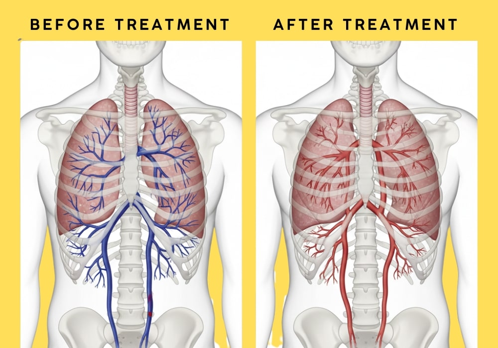Tadalafil Effect on Lung Blood Vessels in Pulmonary Hypertension Medical illustration showing lung arteries with high pressure and relaxation effect after tadalafil use
