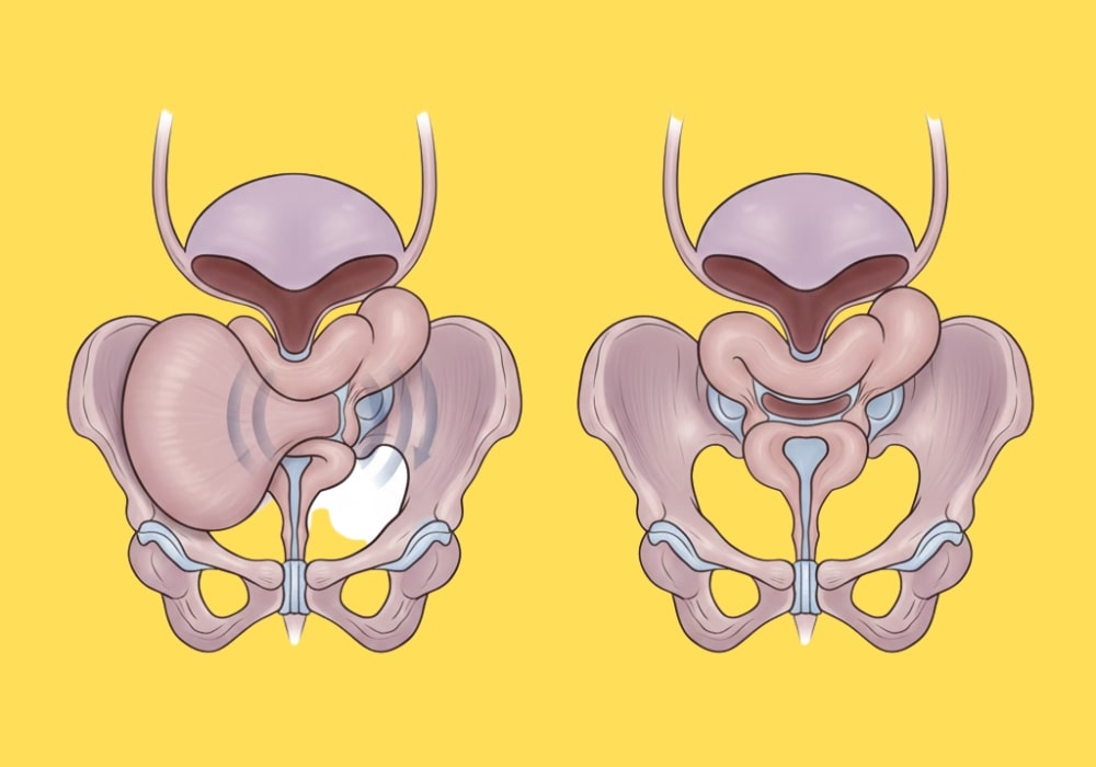 Medical illustration showing enlarged prostate and how tadalafil helps relax bladder and prostate muscles Medical illustration showing enlarged prostate and how tadalafil helps relax bladder and prostate muscles